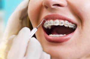 Examining the Advantages of Teeth Braces: More Than Just Straight Teeth