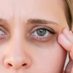 When To Consider Eye Bag Removal For Long Term Puffiness