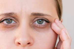 When To Consider Eye Bag Removal For Long Term Puffiness